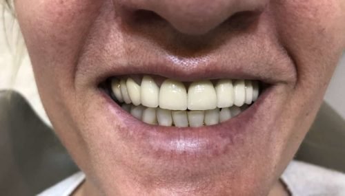 Después del tratamiento: Rehabilitación con implantes y sobredentadura, con locators