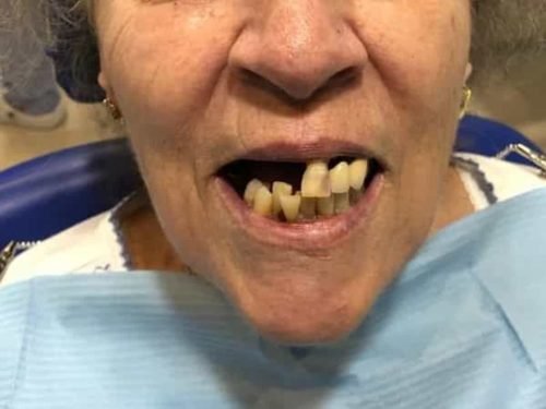 Antes del tratamiento: Rehabilitación con implantes y sobredentadura, con locators