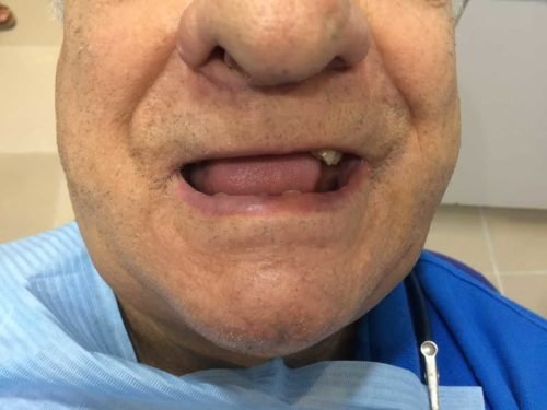 Antes del tratamiento: Rehabilitación con coronas de porcelana
