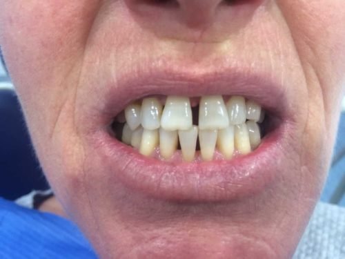 Antes del tratamiento: Rehabilitación con coronas de zirconio