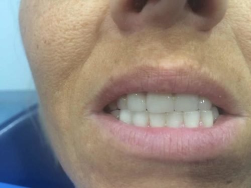 Después del tratamiento: Rehabilitación con coronas de zirconio