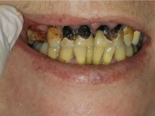 Antes del tratamiento: Rehabilitación con fundas de porcelana